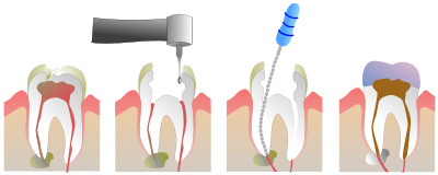 Root Canal Clinics in Chennai Adyar Omr Ecr Triplicane Chrompet