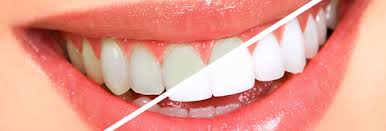Root Canal Clinics in Chennai Adyar Omr Ecr Triplicane Chrompet