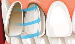 Root Canal Clinics in Chennai Adyar Omr Ecr Triplicane Chrompet