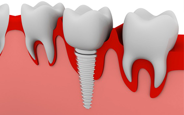 Dentist in Chennai Adyar Omr Ecr Triplicane Chrompet