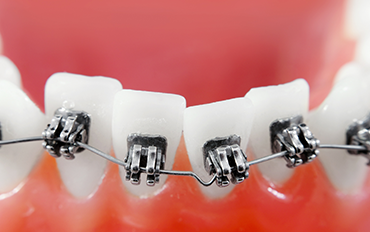 Dentist in Chennai Adyar Omr Ecr Triplicane Chrompet