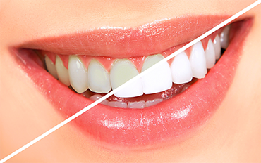 Dentist in Chennai Adyar Omr Ecr Triplicane Chrompet